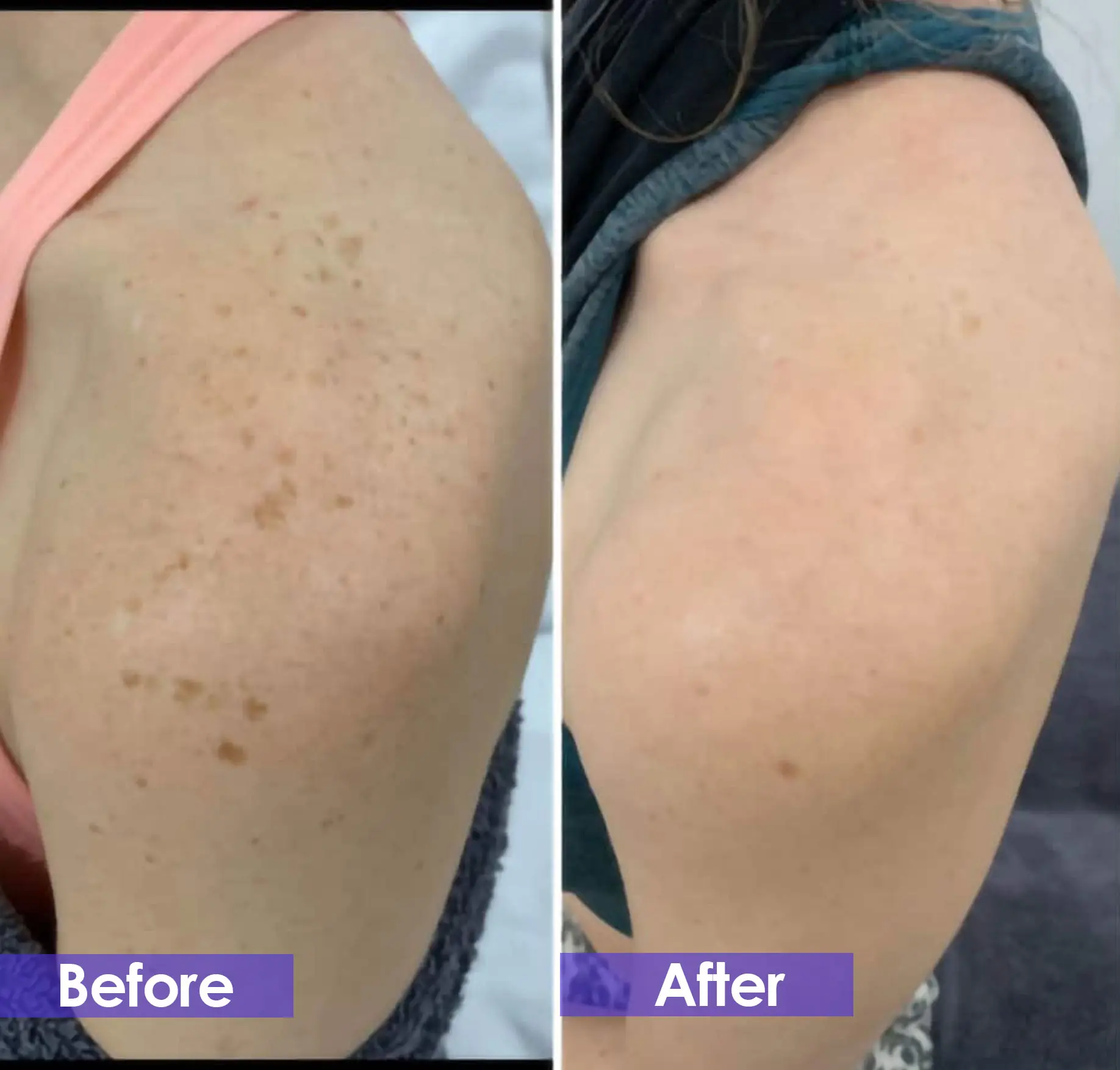 Pigmentation laser treatment price